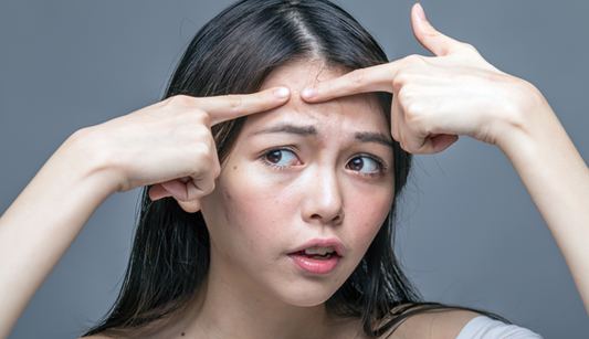 Trị mụn hiệu quả hơn nếu bạn nắm rõ 10 nguyên tắc này
