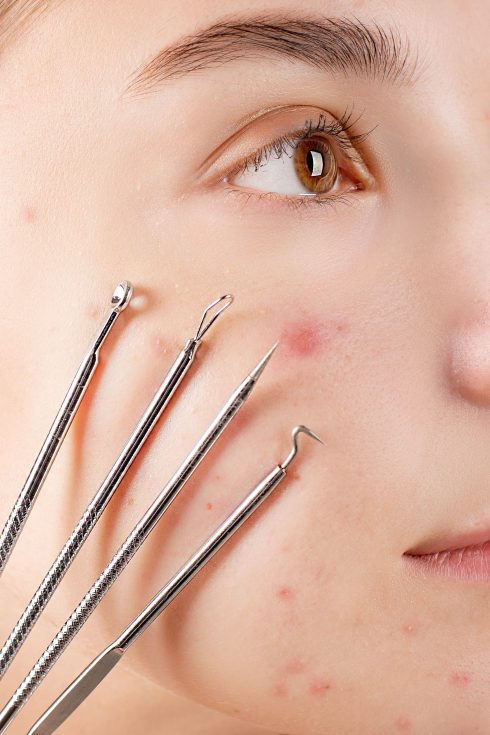 CÁC CHUYÊN GIA KHUYÊN BẠN TRÁNH ĐIỀU GÌ KHI ĐIỀU TRỊ MỤN ĐẦU ĐEN?